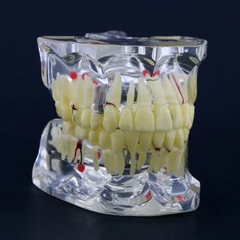 Стоматологические зубы Модель M4001 Обучающие модели Модель имплантата Типодонт Ортоимплантат Патологическая перио Практика